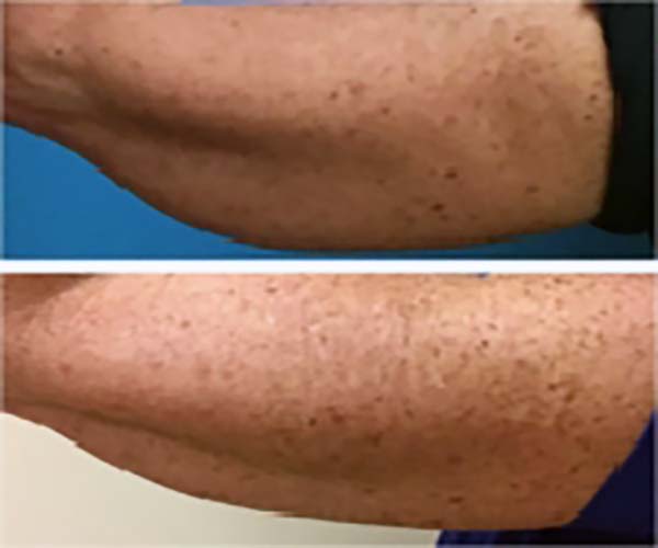 Coolsculpting Before and after 2 treatments