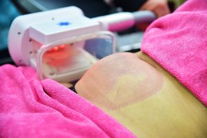 CoolSculpting on belly fat