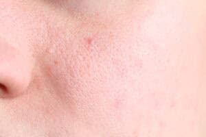 How HydraFacial Cleanses Congested Skin