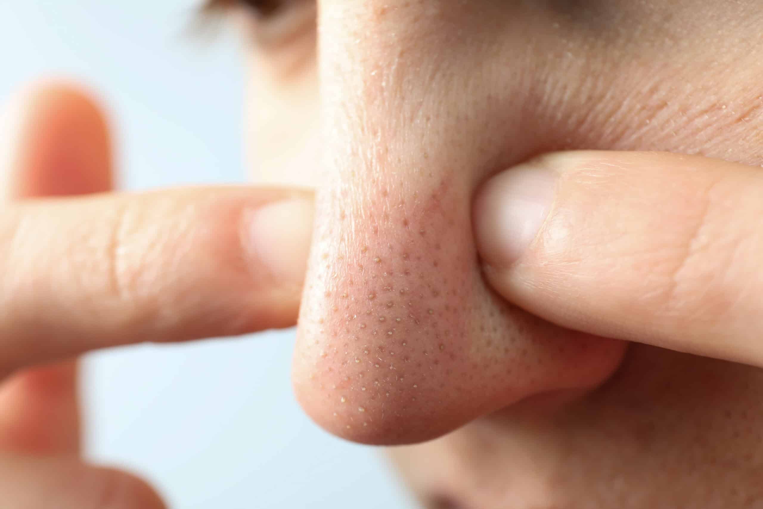 HydraFacial Combat Acne and Clogged Pores