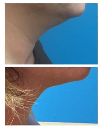Kybella before and after comparison