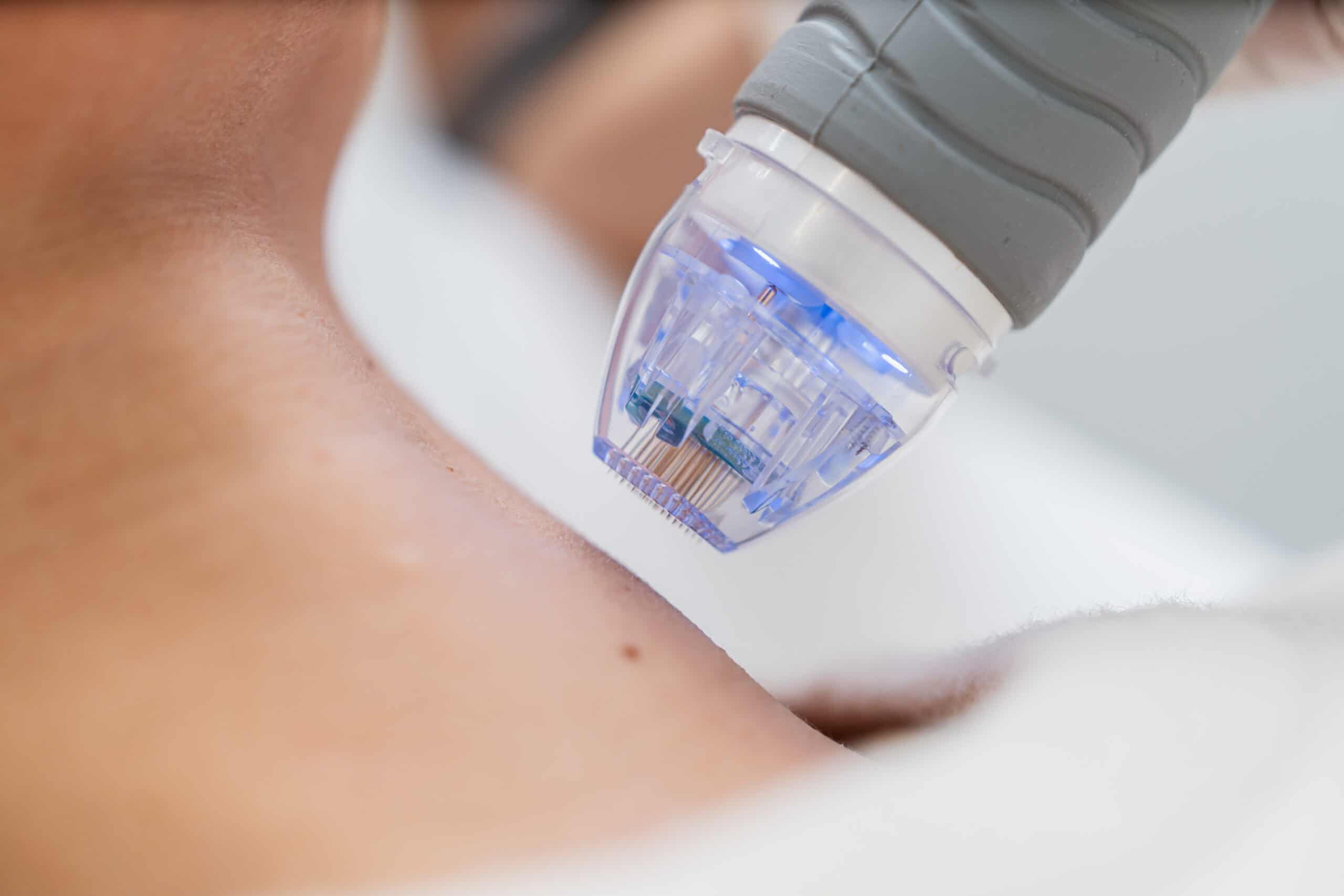 Microneedling Healing Stages