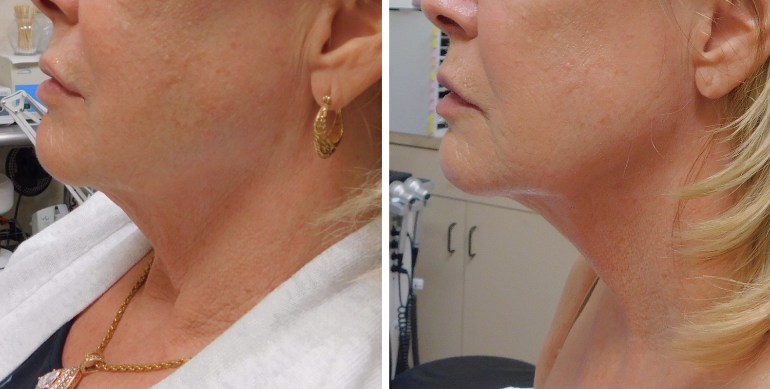 Before and after facial Side View - Lisa Rux