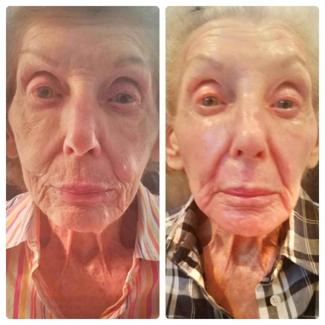 Before and after facial- Lisa Rux