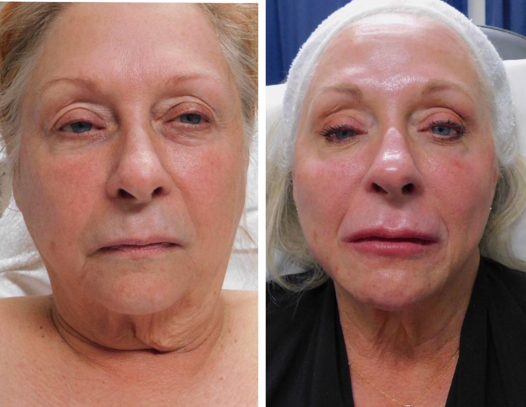 before and after Cosmetic Injectables - Lisa Rux