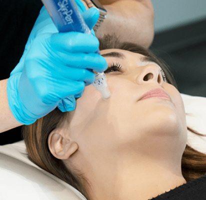 A woman undergoing a SkinPen treatment