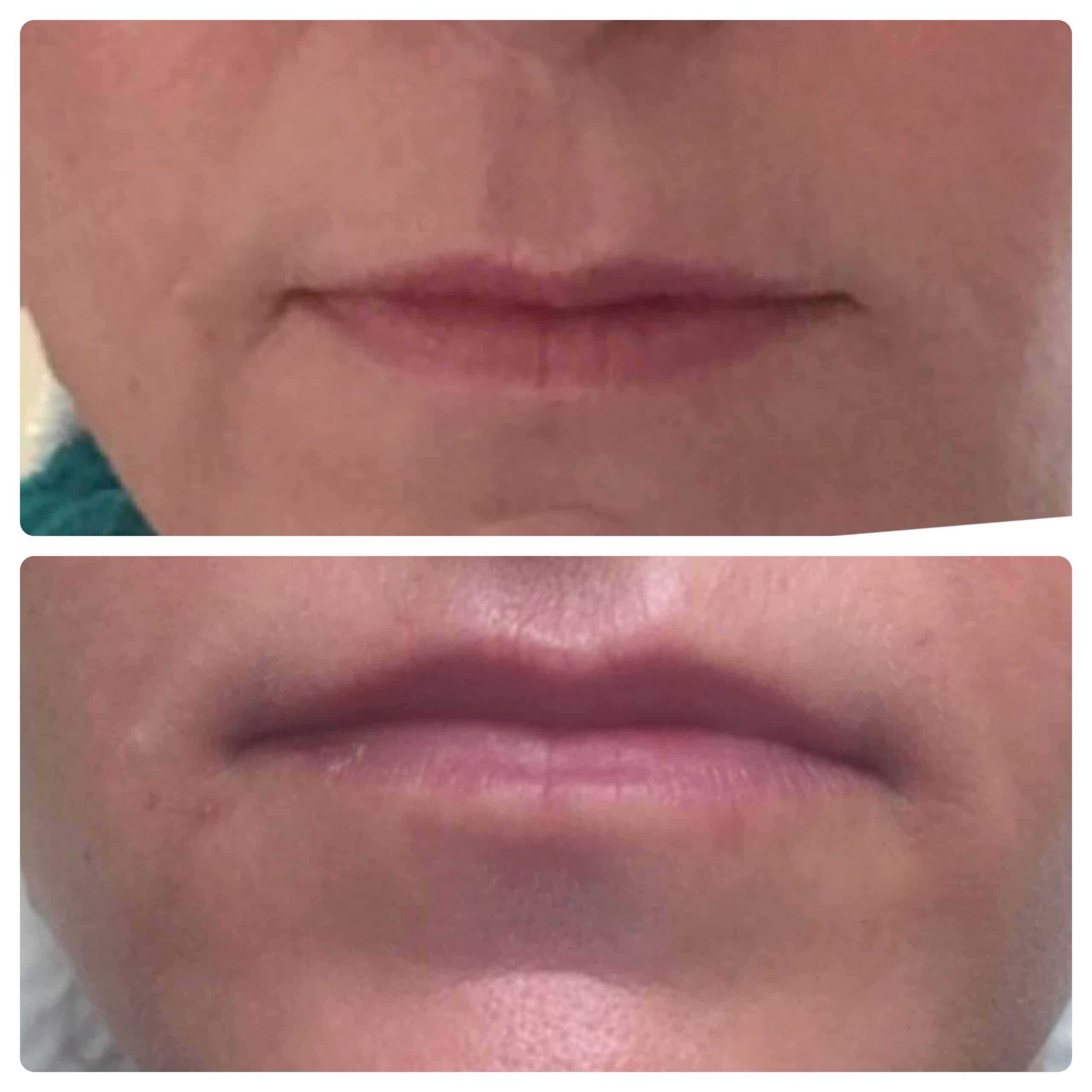 Volbella™ before and after of lip procdure