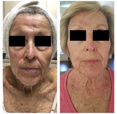 Laser Facial treatment before and after image